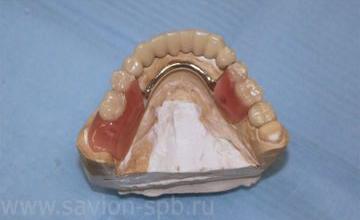 Бюгельные зубные протезы