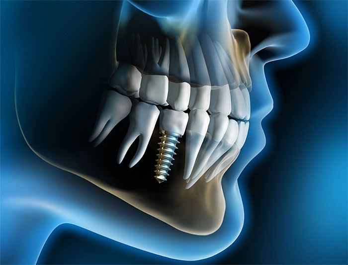 Имплантация для красивой улыбки от Арт Стоматология