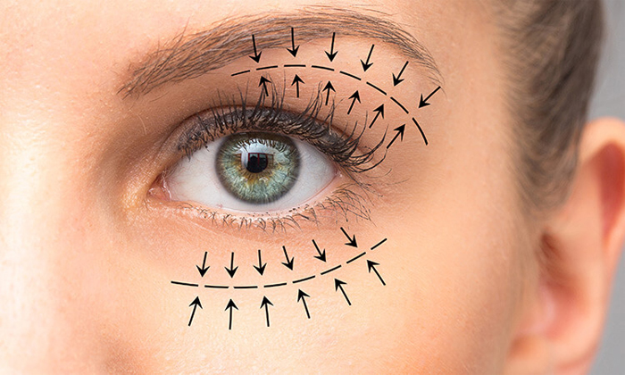 Что такое блефаропластика лазерная?