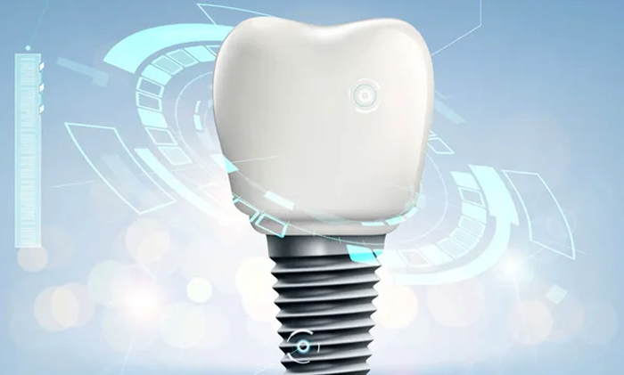 Цифровая имплантация: Передовые технологии для ваших зубов